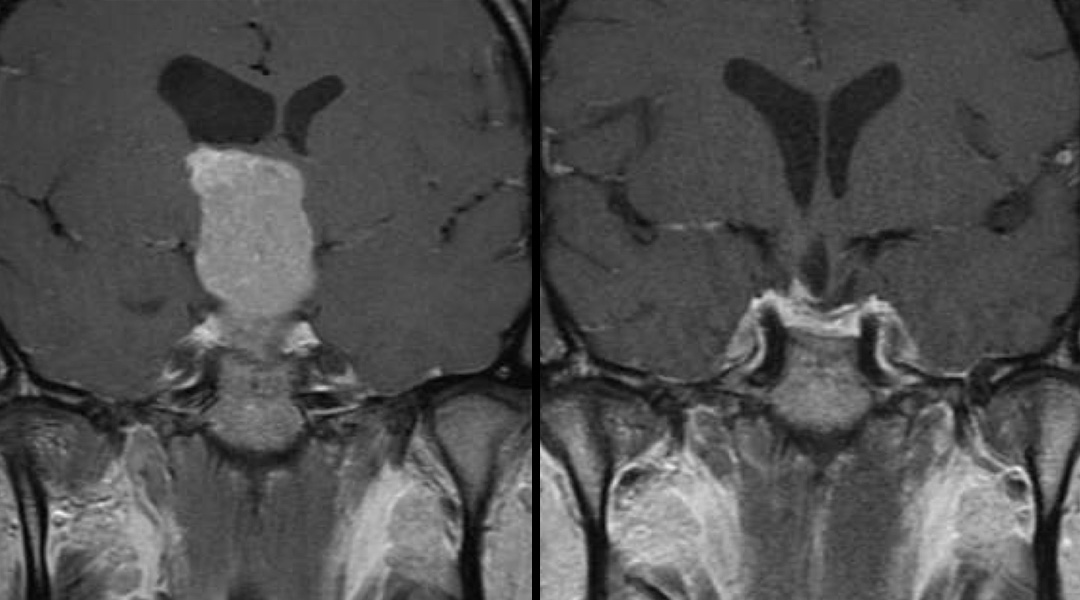 pituitary macroadenoma before and after