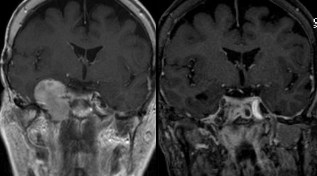 chondrosarcoma before and after