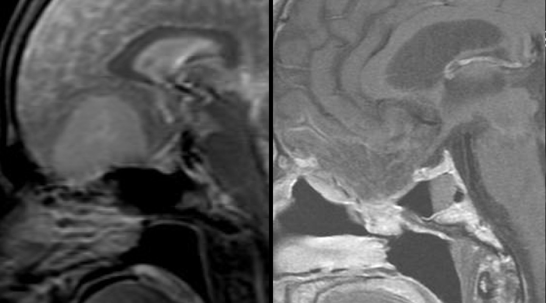 meningioma before and after