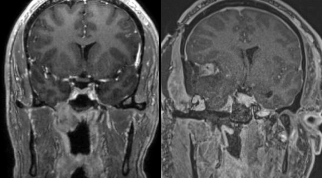 nasopharyngeal befor and after