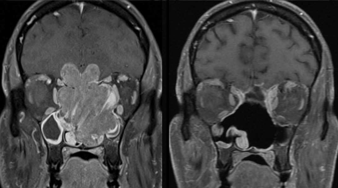 sinonasal before and after