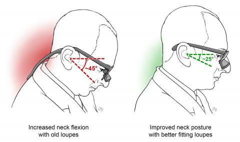 Loupe ergonomics illustration