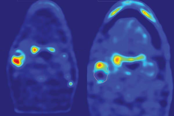 Radiotherapy Brizel 2024 Correct image