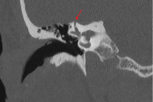 Coronal CT scan showing dehiscent semicircular canal. 