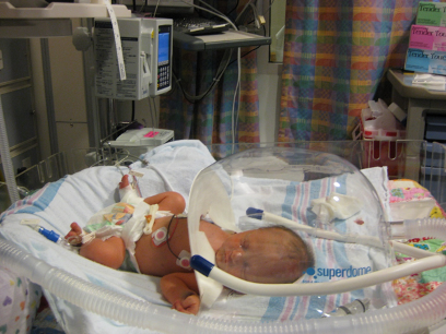 CMV Baby in NICU