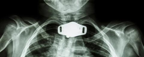 X-ray of an infant who developed subglottic stenosis and required a chronic tracheostomy to bypass the airway obstruction.