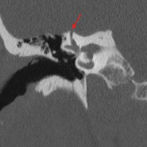 Coronal CT scan showing dehiscent semicircular canal. 
